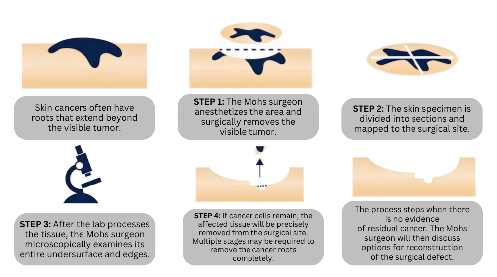 Diagram of Mohs micrographic surgery: the surgeon removes the visible tumor, sections and maps the specimen, examines the undersurface and edges under the microscope, and removes additional tissue until no residual cancer remains before discussing reconstruction